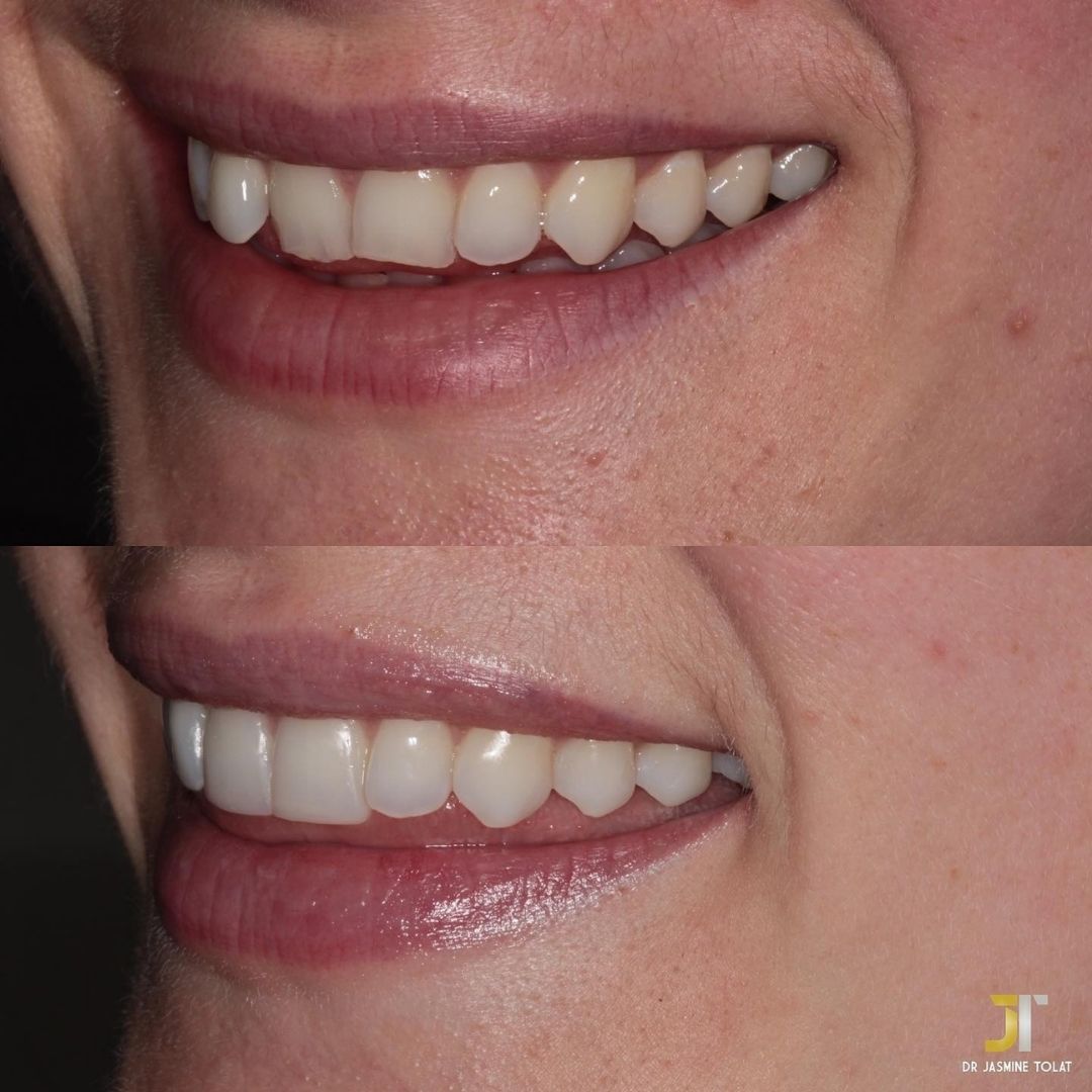 Before and after treatment at Links Dental Practice in Edinburgh