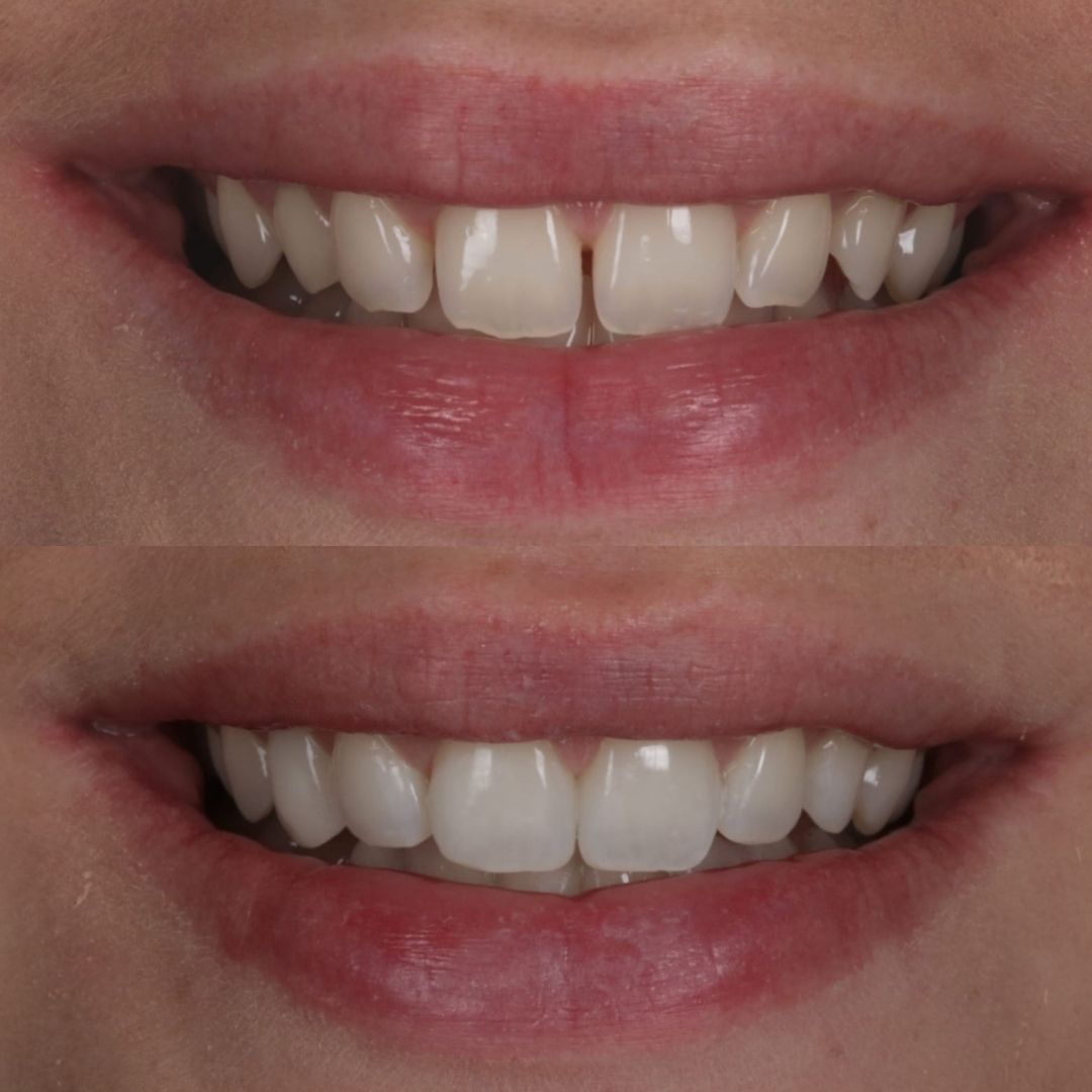 Before and after treatment at Links Dental Practice in Edinburgh