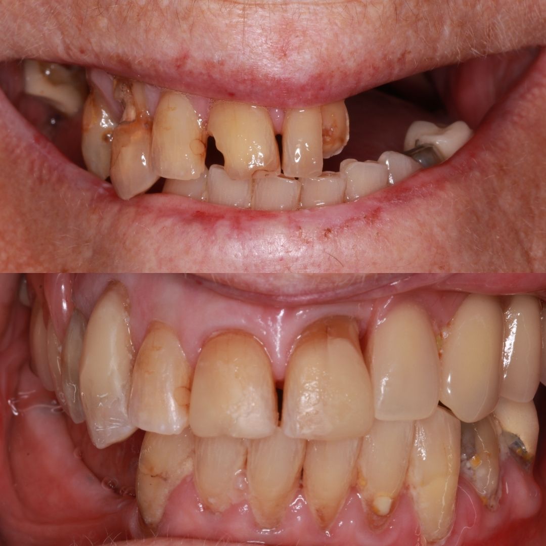 Before and after treatment at Links Dental Practice in Edinburgh