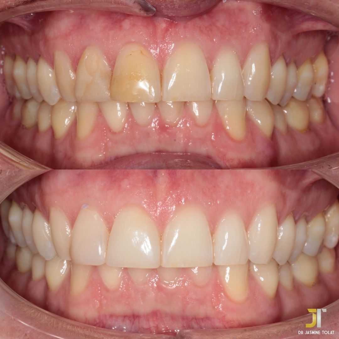 Before and after treatment at Links Dental Practice in Edinburgh
