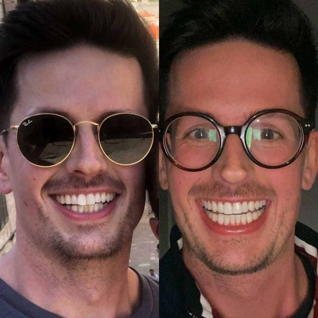 Before and after treatment