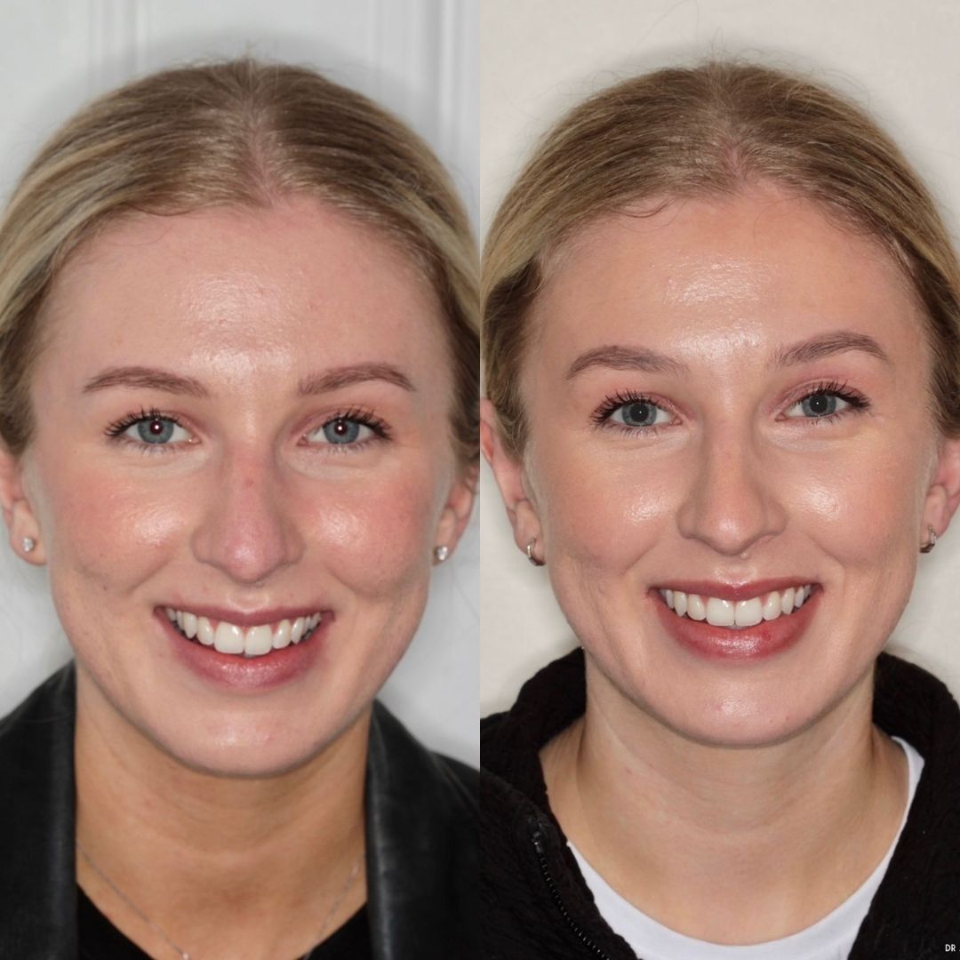 Before and after treatment