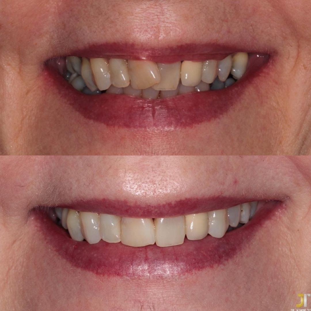 Before and after treatment at Links Dental Practice in Edinburgh