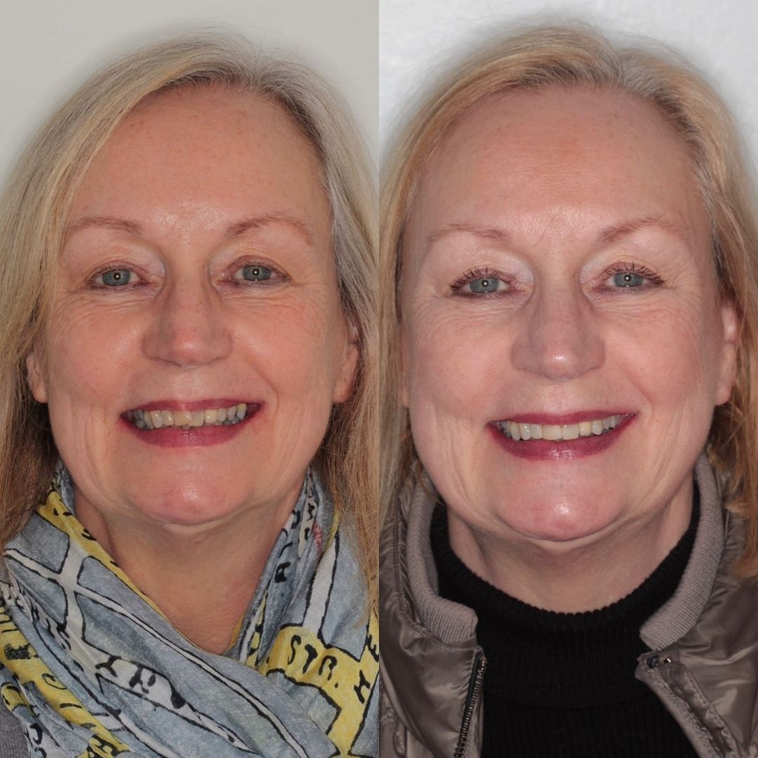 Before and after treatment