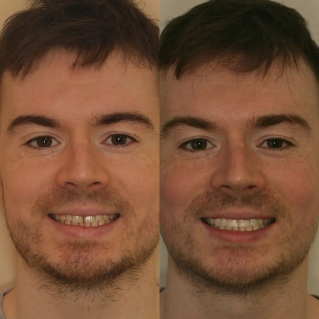 Before and after treatment