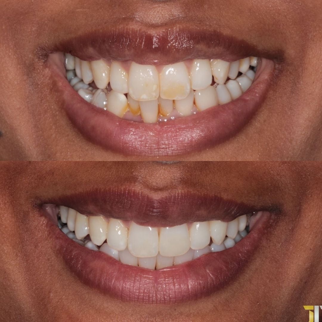 Before and after treatment at Links Dental Practice in Edinburgh