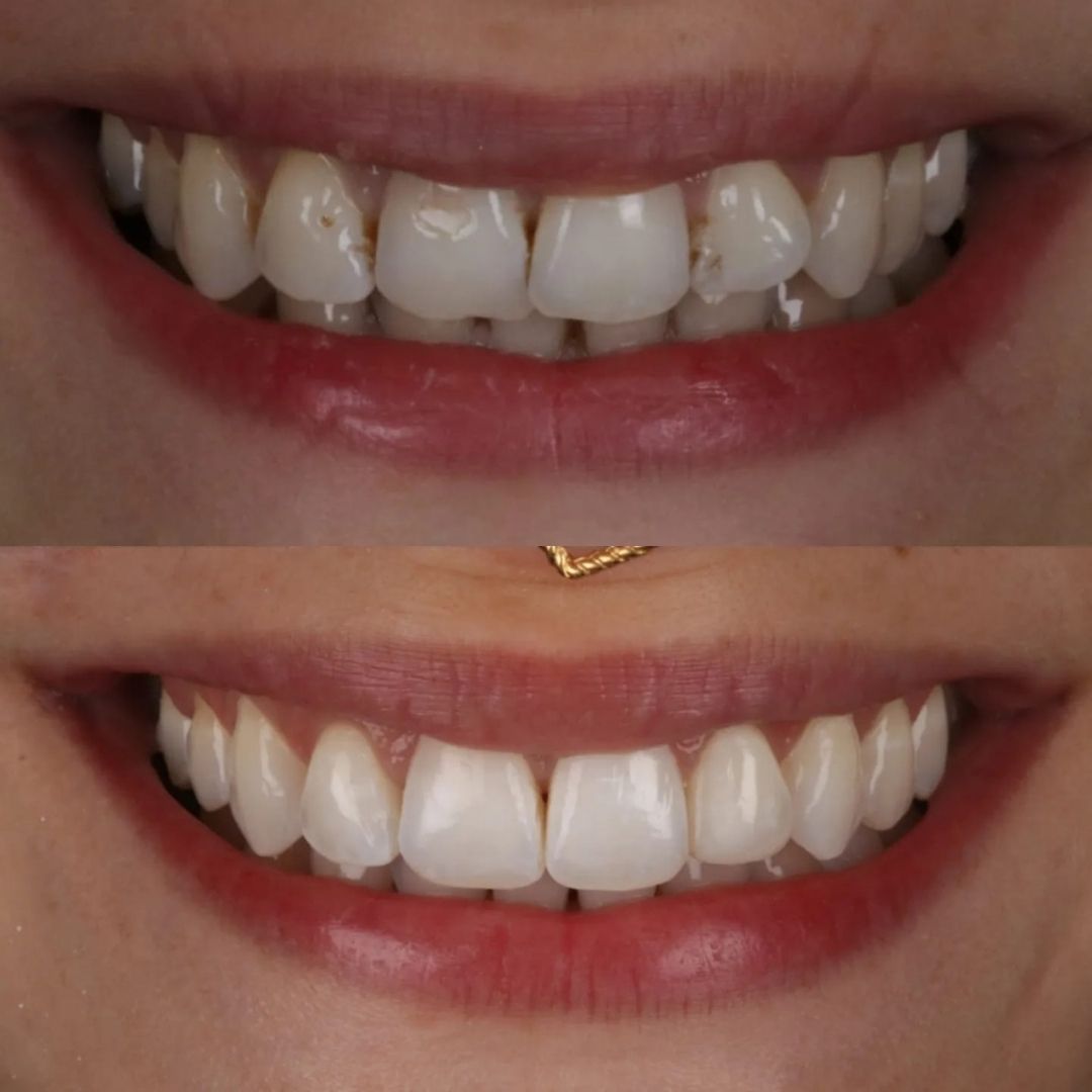 Before and after treatment at Links Dental Practice in Edinburgh