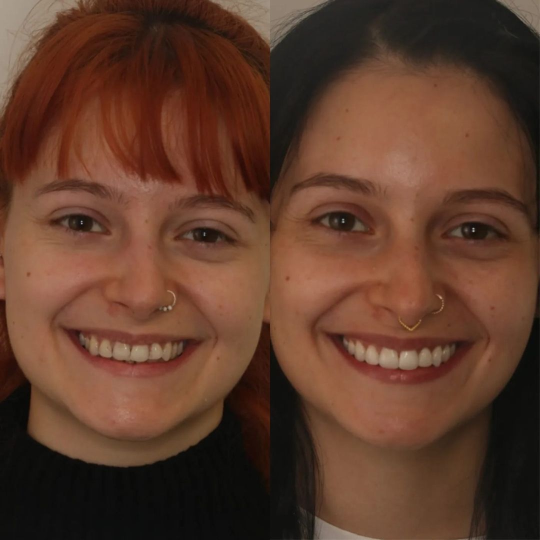 Before and after treatment