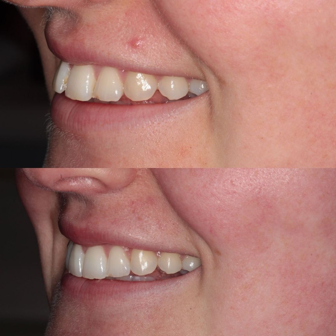 Before and after treatment at Links Dental Practice in Edinburgh