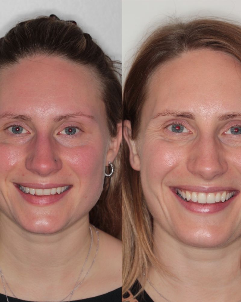 Before & after treatment with Jasmine