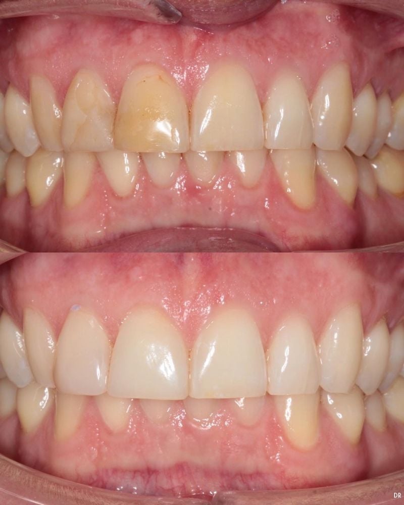 Before & after treatment with Jasmine