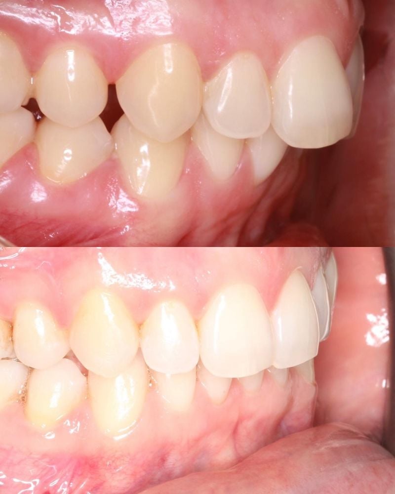 Before & after treatment with Sam