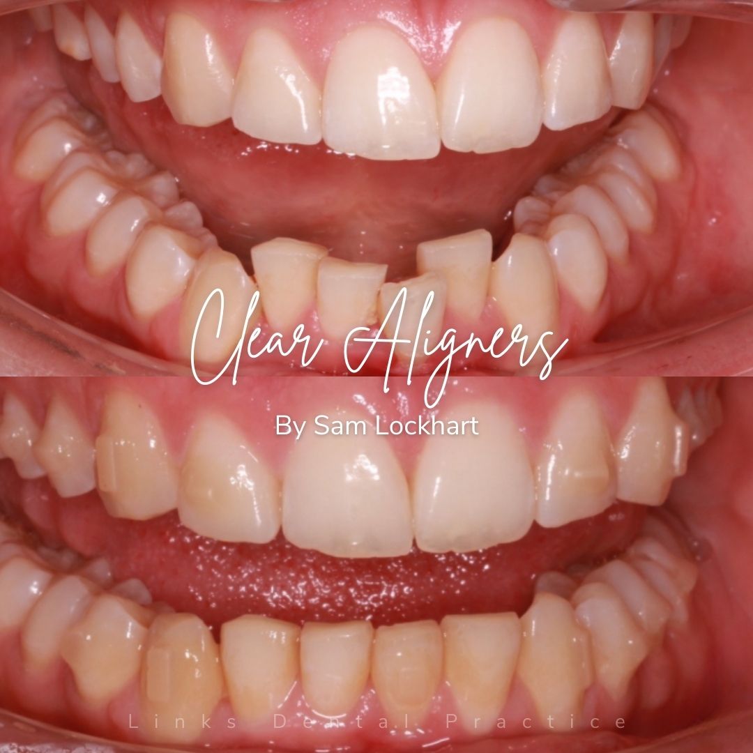 Before and after treatment at Links Dental Practice in Edinburgh