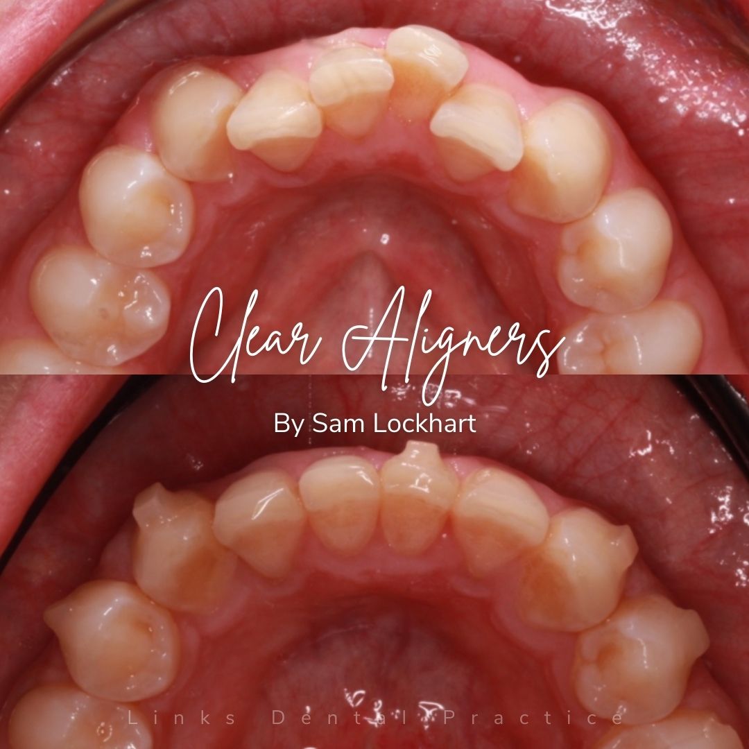 Before and after treatment at Links Dental Practice in Edinburgh