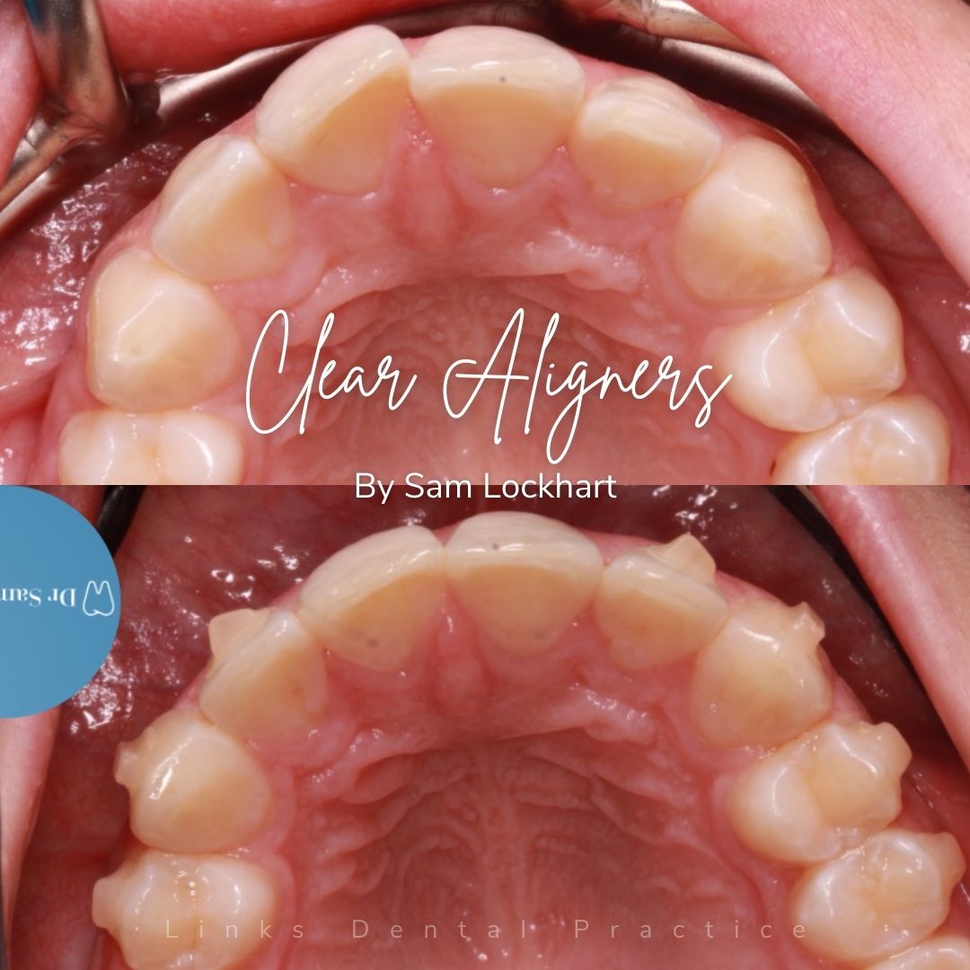 Before and after treatment at Links Dental Practice in Edinburgh