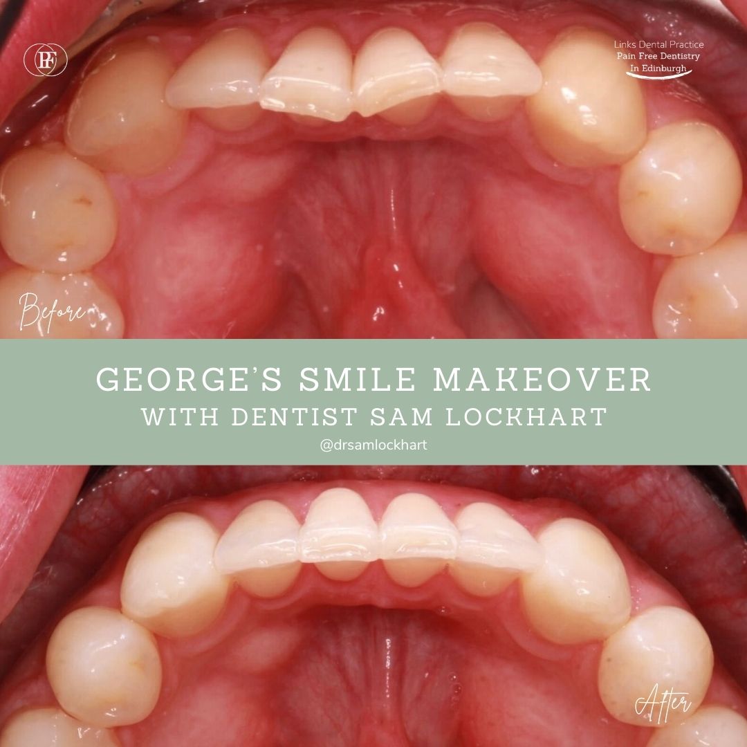 Links Dental Practice | George's Smile Story George's smile makeover