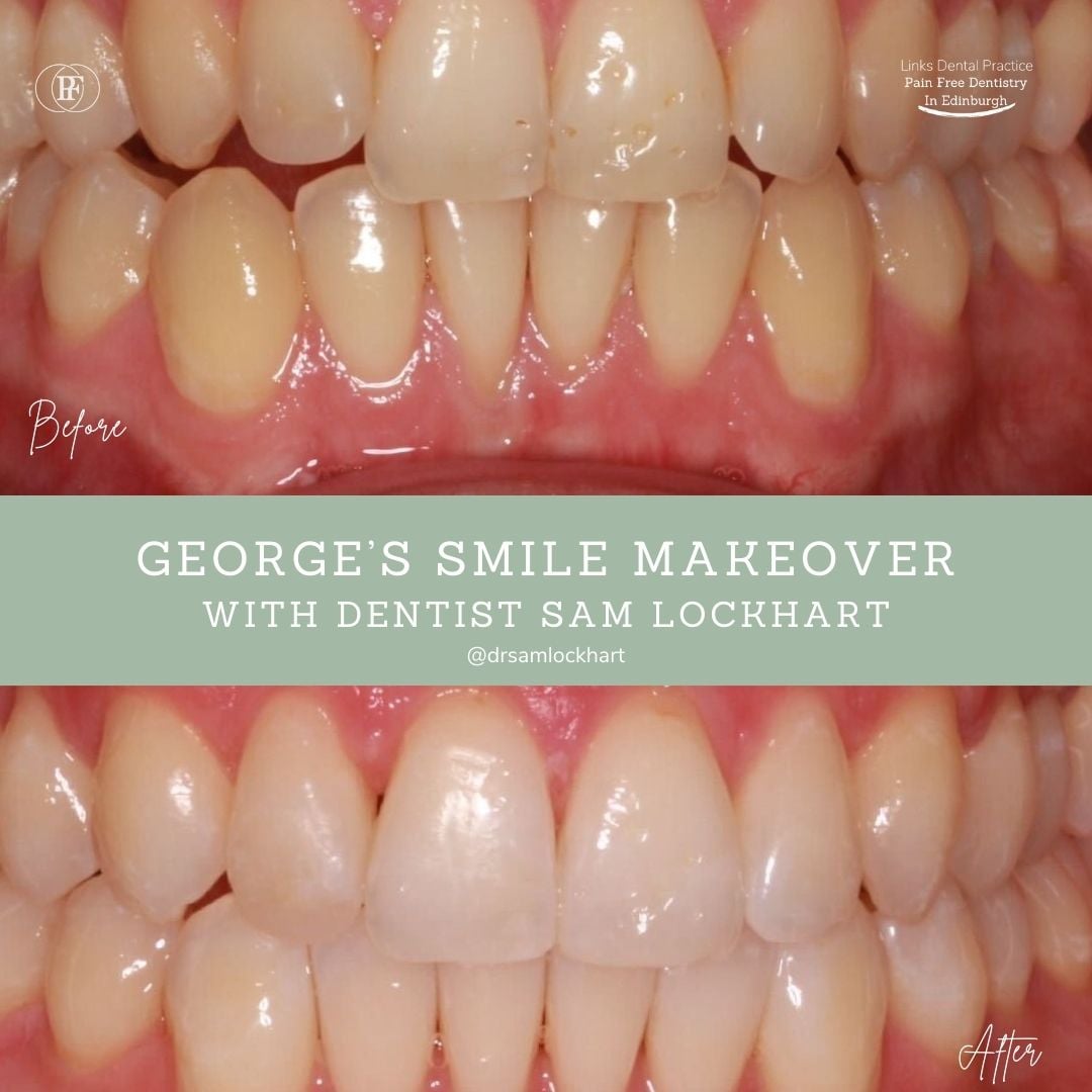 Links Dental Practice | George's Smile Story George's smile makeover