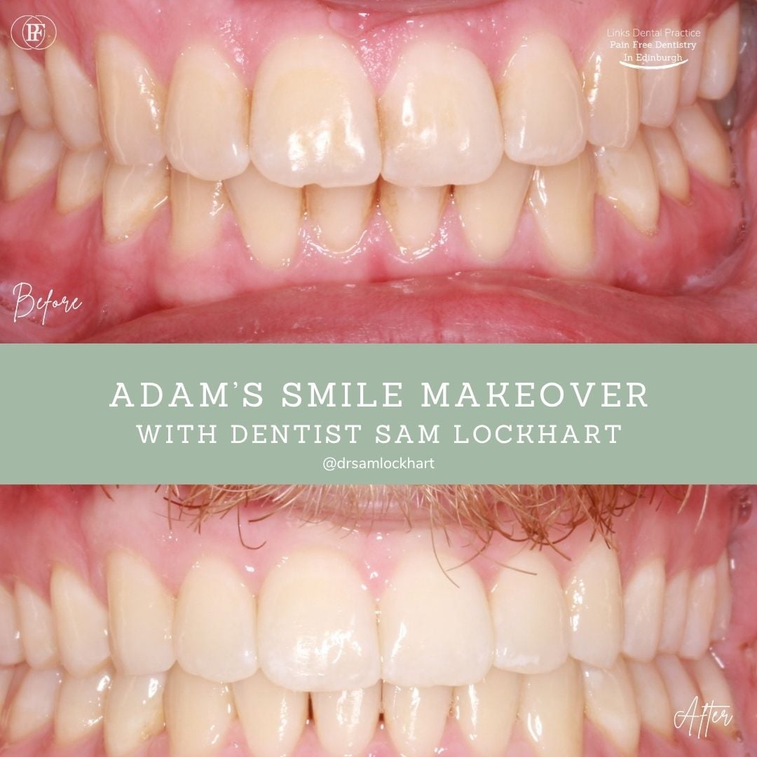 Links Dental Practice | Adam's Smile Story Adam's smile makeover