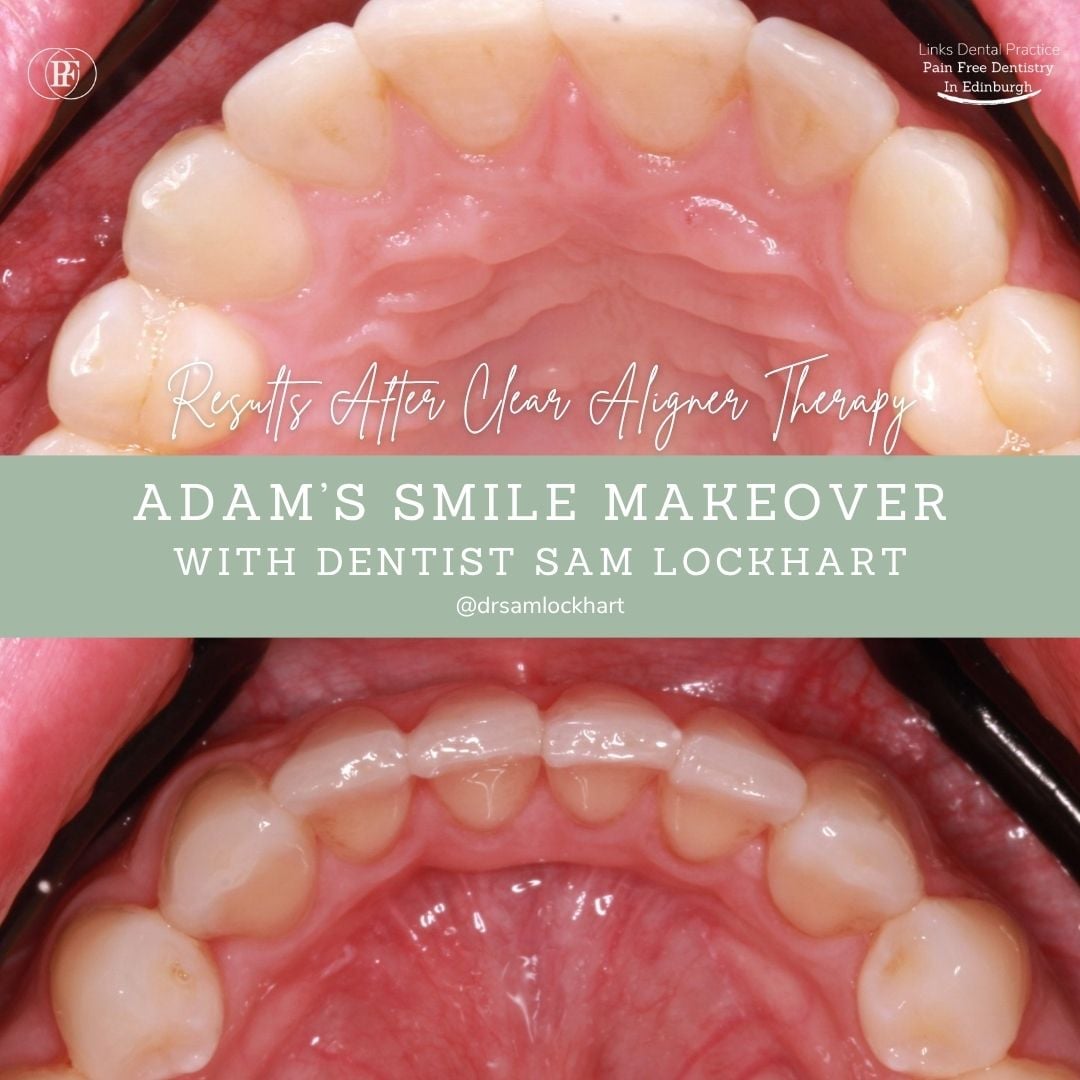 Links Dental Practice | Adam's Smile Story Adam's smile makeover