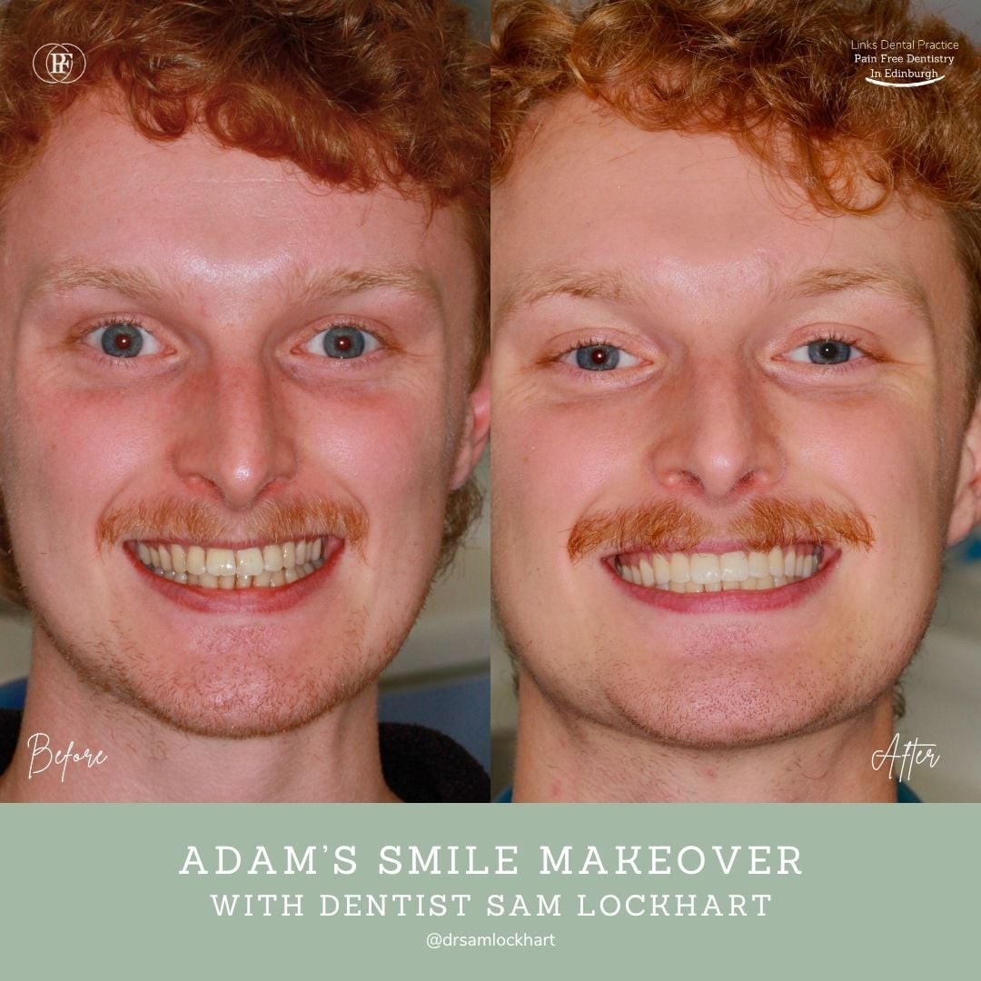 Links Dental Practice | Adam's Smile Story Adam's smile makeover