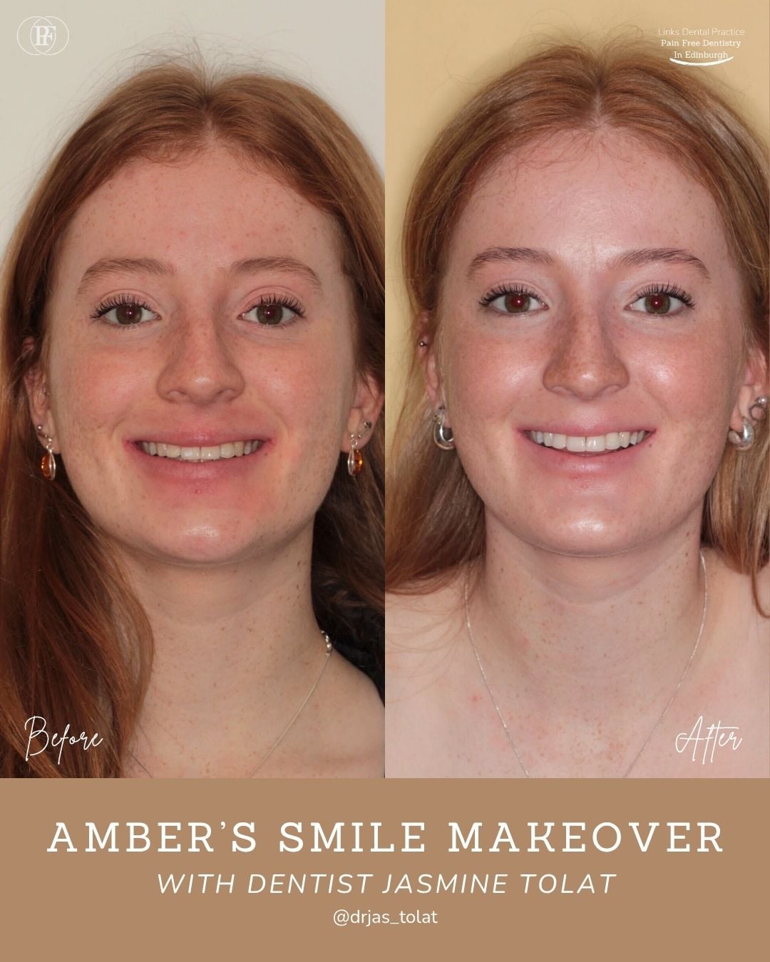 Amber's Smile Story with Jasmine Tolat