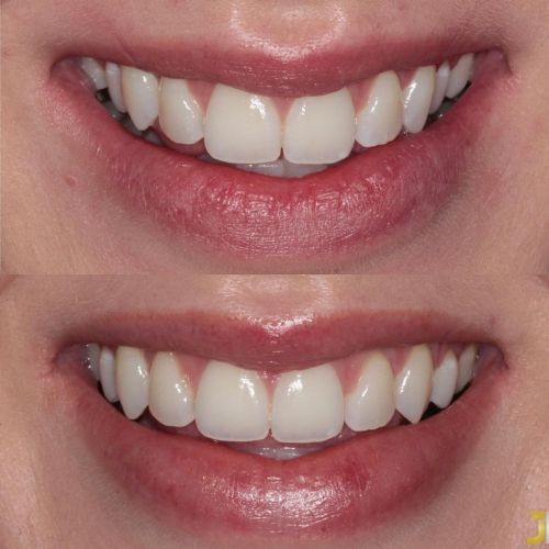 Before and after treatment at Links Dental Practice in Edinburgh