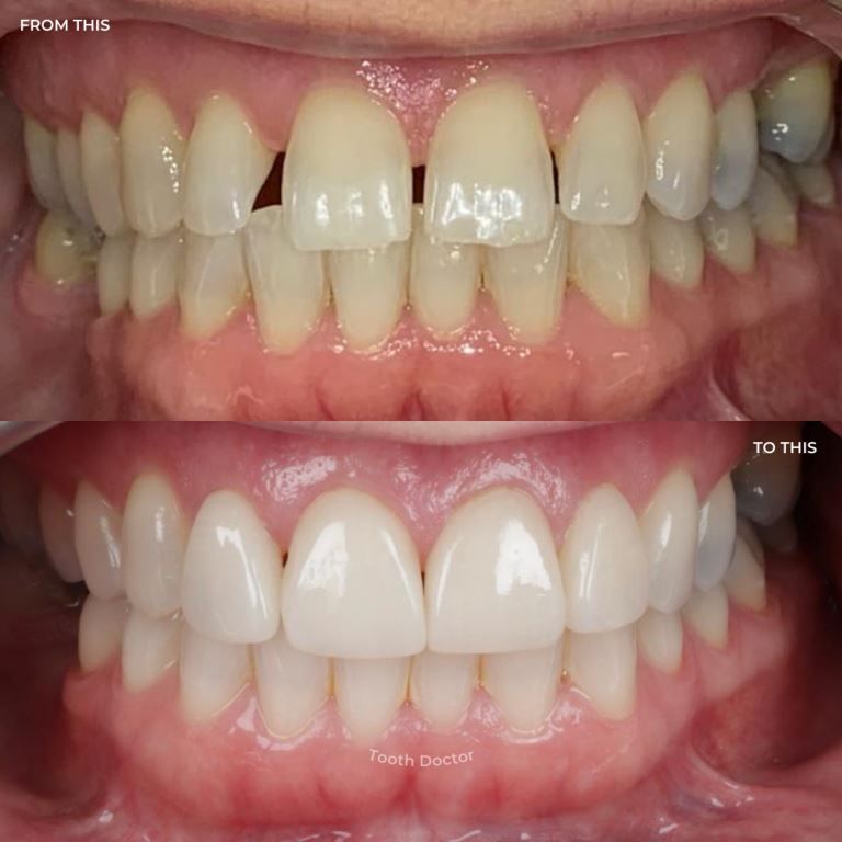 What Are Composite Veneers?